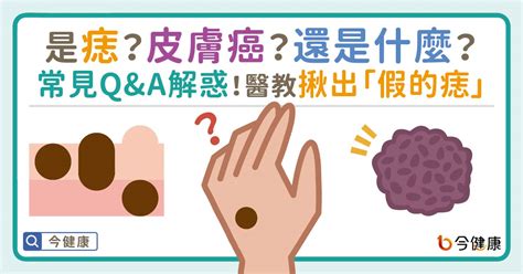 灰色痣|是痣？皮膚癌？還是什麼？常見Q&A解惑！醫教揪出「。